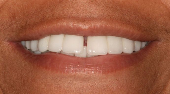 Before veneers procedure